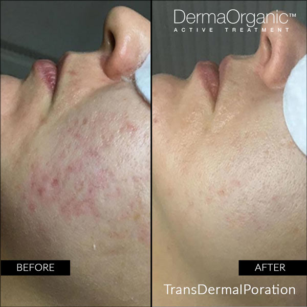 Derma organic Transdermalporation treatment dremation