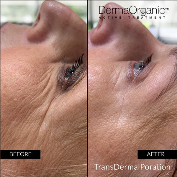 Derma organic Transdermalporation treatment dremation