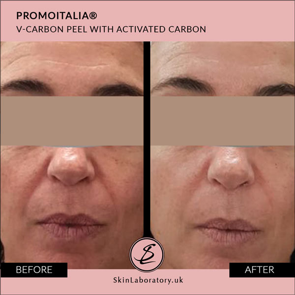 promoitalia v carbon peel before after